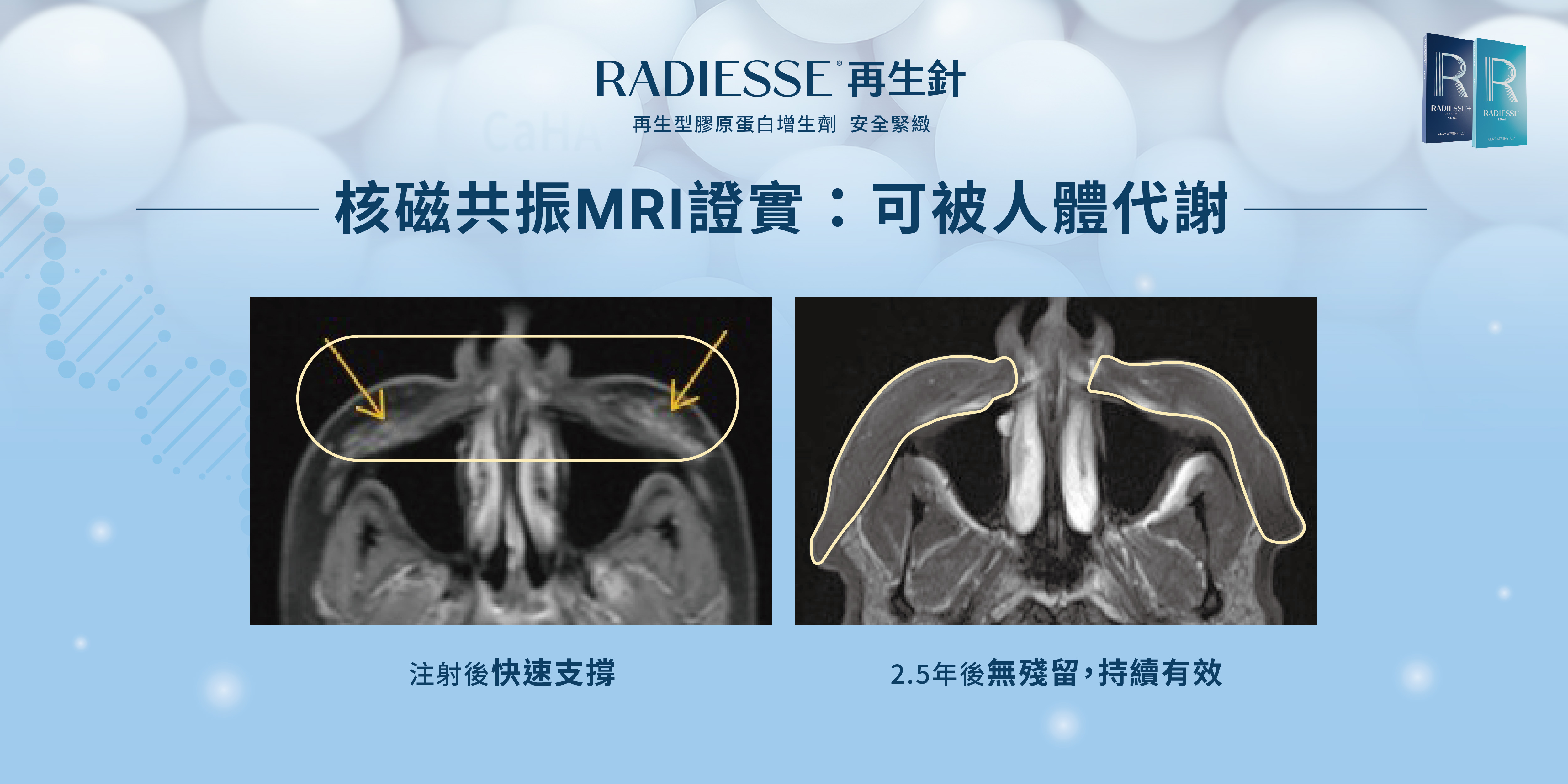 Radiesse 再生針 2.5年後可被人體代謝